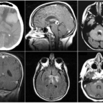 Parenchymal Lymphoma and the Central Nervous System (CNS)